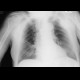 Skin fold on supine chest radiograph: X-ray - Plain radiograph
